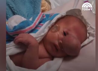 En gigantisk kul stikker ut av babyens ansikt. Se legenes fantastiske jobb!