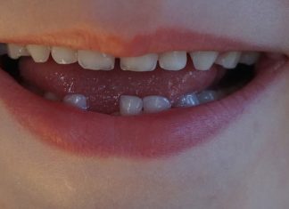 Ditt barns melketenner kan redde barnets liv senere!